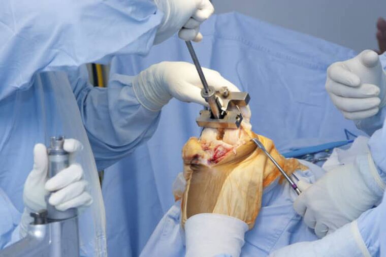 Chirurgie de l'arthrose du genou