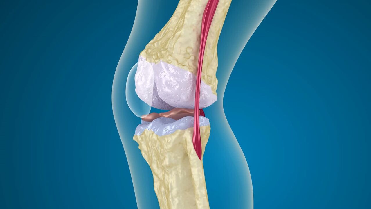 Destruction de l'articulation du genou dans l'arthrose