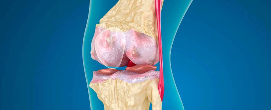 L'arthrose du genou comme cause de douleur