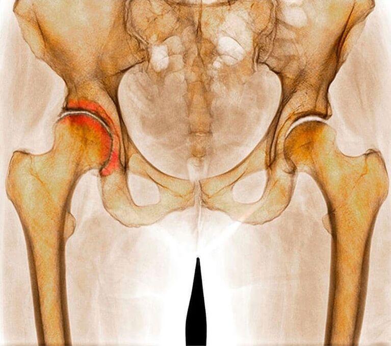 Inflammation de l'articulation de la hanche comme cause de la douleur