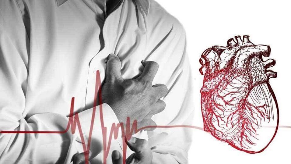 Une extrasystole peut survenir en raison d'une arythmie cardiaque dans l'ostéochondrose thoracique