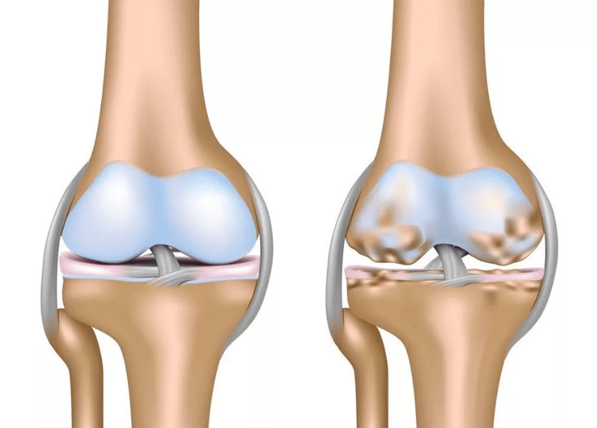 Arthrose