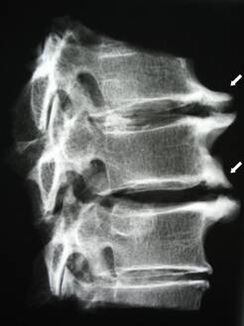 Les ostéophytes de la colonne cervicale provoquent des douleurs au cou
