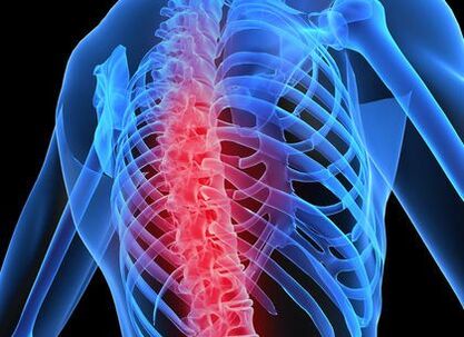 Ostéochondrose de la colonne thoracique