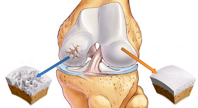 cartilage sain affecté par l'arthrose