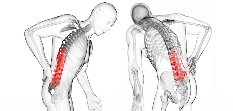 Complications de l'ostéochondrose cervicale