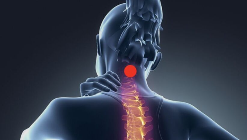 Symptômes de l'ostéochondrose cervicale