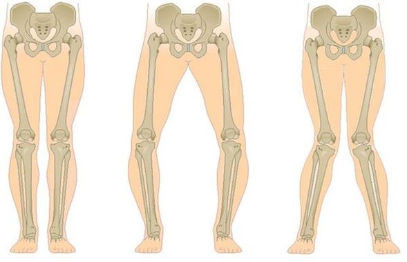 Types d'arthrose