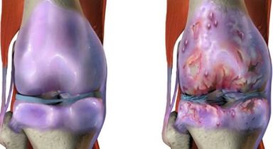 Les principales différences entre l'arthrite et l'arthrose
