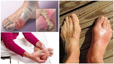 Qu'est-ce que l'arthrite des articulations